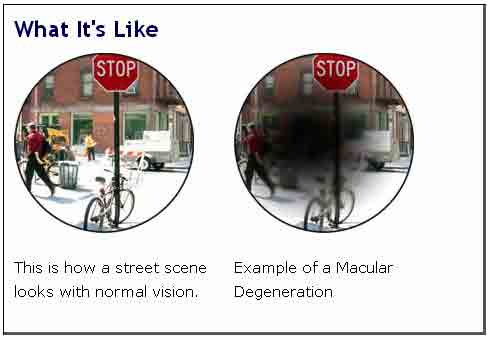 On the left you can see a street scene as perceived with normal vision, on the right, the same street as seen by someone with ARMD
