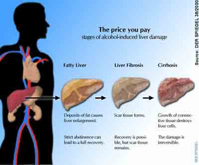 The three types of  Liver Disease - fatty liver, hepatitis, and cirrhosis of the liver