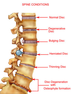 Various problems can alter the structure of the spine and/or damage the vertebrae creating pain and difficulties with mobility.