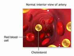 A high LDL level leads to a buildup of cholesterol in your arteries, the large blood vessels that carry your blood to your heart 