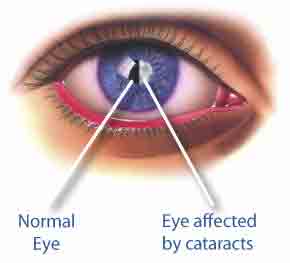 this is the picture of an eye divided in two, the left hand side shows an eye without cateracts and the right -hand side depicts an eye affected by cateracts
