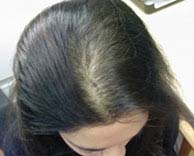 women can also develop male pattern baldness, which unfortunately causes psychological distress and lack of self esteem 