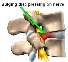 A herniated disc is a common back condition that leads to irritation of spinal nerves and can cause pain in the back, hips and legs. 