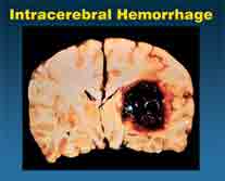 an intracerabral hemorrhage or haemorrhage is often caused by prolonged hypertension or high blood pressure which is not treated