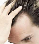 Male pattern baldness is the most common form of hair loss.