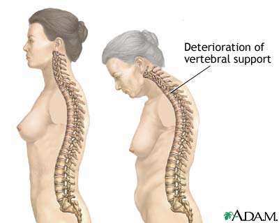 osteoporosis causes:bone degeneration provoked by calcium deficiency and low levels of sex hormones are some of the causes of osteoporosis