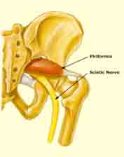 When the sciatic nerve is compressed or otherwise irritated by the piriformis muscle this causes pain.
