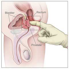 Panel on the right shows an enlarged prostate pressing on the bladder and urethra,