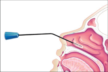 turbinate coblation is an effective treatment for nasal obstruction and can help relieve allergy symptoms, snoring and sleep apnea