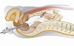 transcolonic Notes surgery (natural orifice surgery) promises less pain, no external scars and a rapid recovery, cutting edge to say the least (excuse the pun)