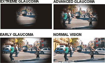 Glaucoma is a disease which causes damage to the optic nerve, the nerve that carries visual information from the eye to the brain. 