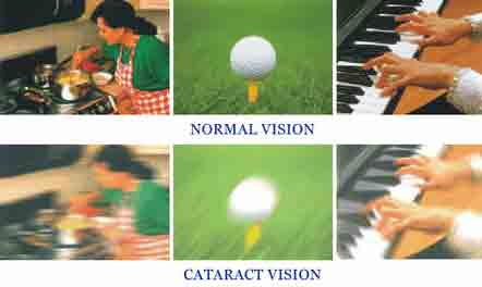 In this graphic, the top three pictures show normal vision, whereas the bottom three show vision with cateracts