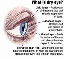 Dry eye is a condition in which there are insufficient tears to lubricate and nourish the eye.