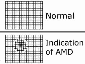 These pictures show how a street scene looks with normal vision and how it looks for someone with AMD or Macular Degeneration