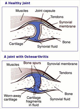 Cartilage is a flexible connective tissue found in healthy joints which stops the connecting bones from rubbing together,