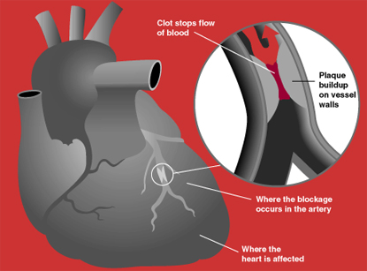 Important risk factors for heart attacks are previous cardiovascular disease, older age, tobacco smoking..