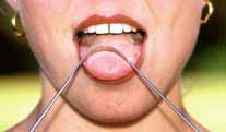 Cleaning the tongue with a  tongue scraper  ie designed to clean the bacterial build-up, food debris, fungi, etc from the tongue and to eliminate halitosis